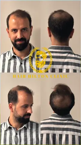 HAİR TRANSPLANT  #hairtranplant #saçekimiturkiye #hairtransplantation 