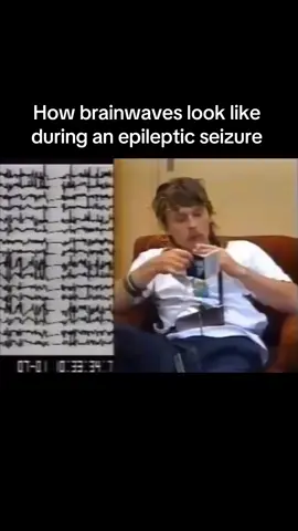 How brainwaves look like during an epileptic seizure  .                          . .                          . .                          . .                          . My Ig (spaceXplorer2023) .                                         . Hashtags #brainwaves #epileptic #man #scary #health #brain #fy #viral #SpaceXplorer #_ecsb_ 