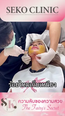 #เซโกะคลินิก #เซโกะรีวิว #รีวิวหัตถการที่ทํา #ร้อยไหมหน้าเรียว #ร้อยไหมเหนียง 