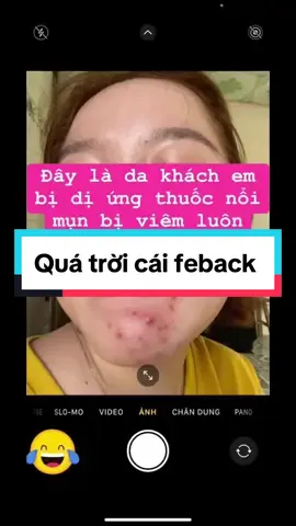 Quá trời cái feedback Da khách mụn viêm nặng mà sử dụng mới nửa tháng là trộm vía da đở hẳn luôn. Sử dụng hết 1 bộ chắc xuất sắc luôn quá😛😘😘 Chị em trình trạng da mụn không đều màu, sd đủ loại kem không bớt thì thử em kem Meiduzi bên em xem sao nhé!!! Chăm da không chỉ ngày tết mà mỗi ngày đều phải đẹp để tự tin nhé chị em❤️❤️❤️#FACE_MEDUZI_NHẬT_CHÍNH_HAÃNG #sạchnám #sạchmụn #phanbietkemgiathatfacemeiduzi 