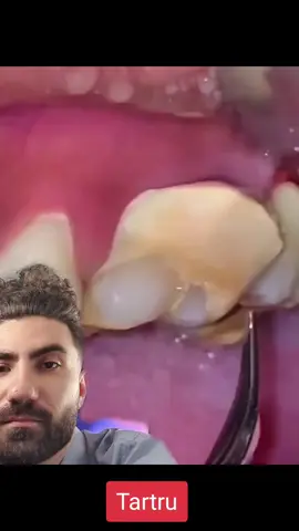 #duet with @Mhasamuv.2 Dentist reactioneaza - tartru #tartar 