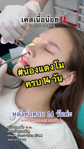 สวยมากก จึ้งมากก ลูกสาวWefriendclinicค่ะ iiก้จมูก+รองปลายหลังหู+ตอกปรับฐาน+ตกแต่งปลาย #น้องแตงโม หลังทำครบ 14 วันค่ะ หน้าสวยหวาน ละมุน ทรงสโลปปลายพุ่ง สวยจึ้ง สวยครบจบทุกองศาจริงๆเลยค่ะ  เราพร้อมดูแล  ความสวย  ความหล่อ Wefriend clinic  ❣️คุณหมอให้คำปรึกษา แนะนำก่อนเข้ารับการผ่าตัดทุกเคส  ❣️รับประกัน 1 ปีเต็ม ตั้งแต่วันที่เข้ารับการผ่าตัด  กรณี เบี้ยว เอียง อักเสบติดเชื้อ ทะลุแก้ไข(ฟรี)  ❣️บริการดูแล After care หลังการผ่าตัด นัดติดตามผล / พบแพทย์ตลอดระยะเวลา 1 ปีในประกัน #Wefriendclinic #วีเฟรนด์ #คลินิกที่มีคนบอกต่อเยอะที่สุด #คลินิกดูแลดี #คลินิกสะอาด #คลินิกทรงจมูกสวย  ⭐️ปรึกษาสอบถามเพิ่มเติมค่ะ ⭐️ TEl : 0922429425 Line ID: @wefriendclinic