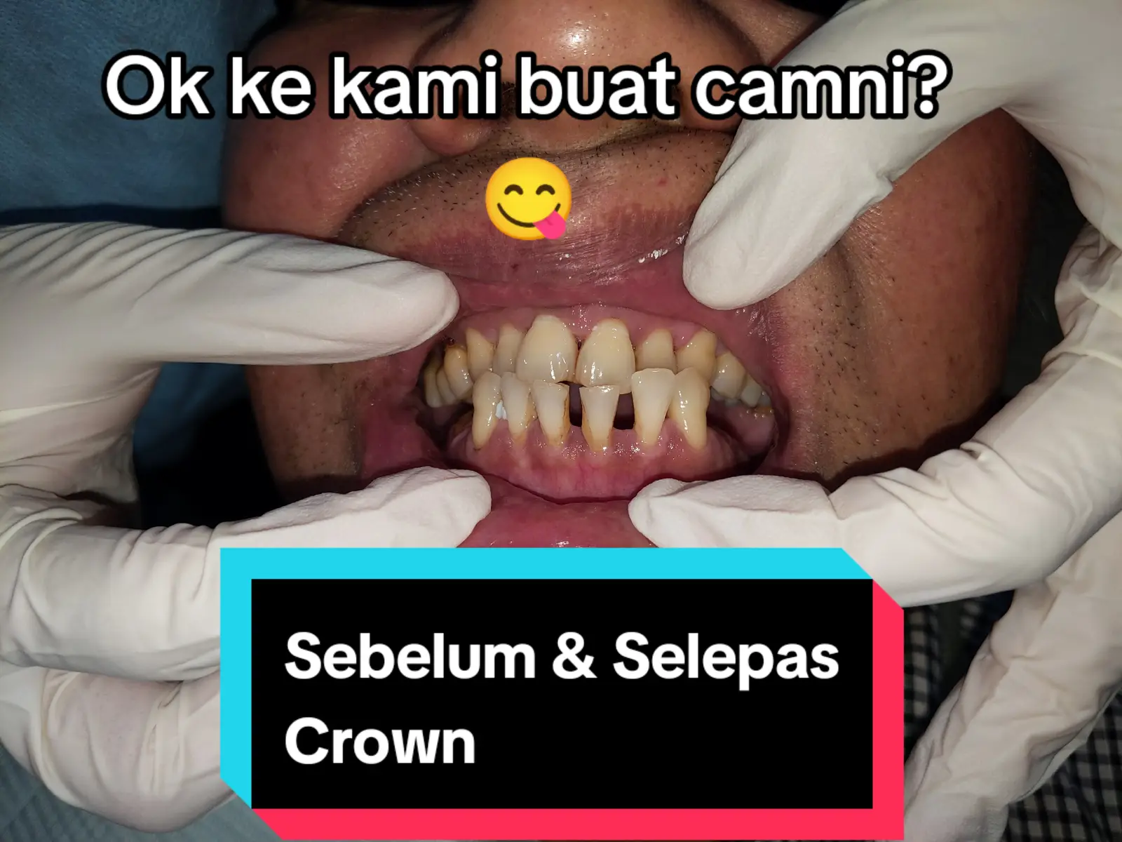 minggu pertama disember ni sibuk sgt dengan patient crown. penat tapi puas hati dpt bantu patient 🥰 alhamdulillah patient ni anaknya buat braces dgn Dr Fariq, satu family buat rawatan kat sini. terima kasih percayakan Amalmedik utk buat rawatan crown dengan kami. 🤗 #klinikgigikelantan #dentalcrown #klinikpergigianamalmedik #dentalbridges #jambatangigi #klinikgigikotabharu 