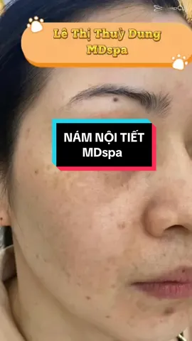 Xong ca #nám_nội_tiết cho chị gái siêu đẹp 🤗#lêthithuydung616 #mdspa_chuyên_mụn_rỗ_tpvinh #chuyên_đtri_mụn_rỗ_tpvinh_nghệan #nám_tpvinh 