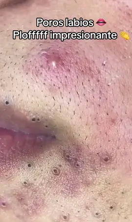 #extractions#puntosnegros#acne #grasa#espinillas #granos #poros #facial #relajante 