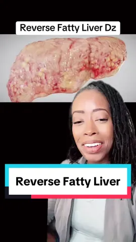 Fatty Liver Disease is not something you have to live with. It is reversible! Many people are living with Nooholic Fatty Liver Disease (NAFLD) and don’t even know it! There may not be signs until you are having significant liver damage, and if a lab test can pick it up, that means there has been some damage to the liver already. Its better to prevent and reverse if you suspect it. Depending on how advanced the disease is you may be able to turn it around. Don’t let it go from NonAlcoholic Fatty Liver Disease (NAFLD) to NonAlcoholic steatohepatitis (NASH) to Cirrhosis and possibly Hepatic Cancer. The further you go, the less reversible! #healthy #fattyliverdisease #fattyliver #nash #liverdisease #reversedisease #healthtips #LearnOnTikTok #lifestylechanges #wellness #healthcoach #houston #weightloss #locs #trending #funny #eatthisnotthat #greenscreen 