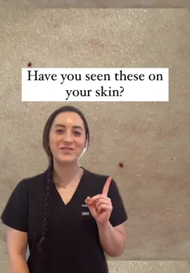Have you seen these on your skin? These are Cherry Hemangiomas (AKA Cherry Angiomas). They are the most acquired BENIGN vascular neoplasms. While no treatment is necessary, there are cosmetic options available.  #derm #dermatology #knowyourskin #boardcertifieddermatologist #skincare #skincaretips #skincareroutine #health #medicine #drsaussy 