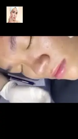 #squeeze #squeezeyuk #acne #pimple #pimplepop #blackhead #satisfying #foryoupage 16