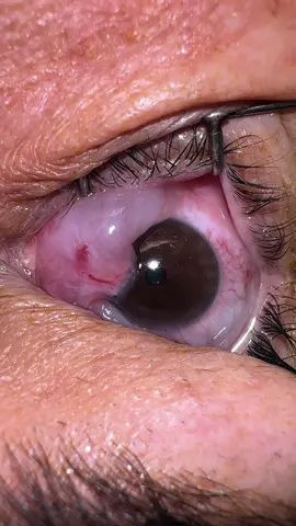 Cirurgia de Pterigio  pterygium surgery  Vamos cuidar dos olhos?  Casos de oftalmologia #oftalmologia #eyes #olhos #ophthalmology #medicine #curiosidades #dicas 