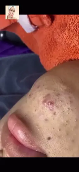 #squeeze #squeezeyuk #acne #pimple #pimplepop #blackhead #satisfying #foryoupage 124