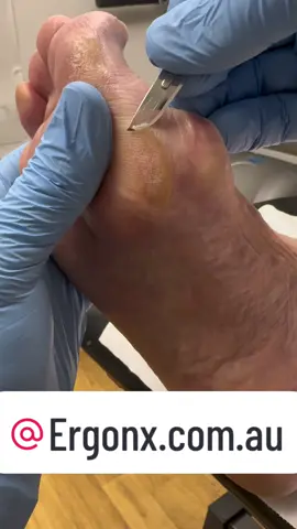 Thick callus (hard skin) cut from foot by podiatrist #ergonx #docpods #hardskin #cutting #callus #corn #foot #feet #satisfying 