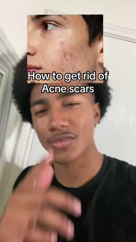 How to get rid of ance scars #haskell_1x #haskellramirez #trending #acnescars #acne #greenscreen #greenscreensticker 