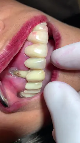 🦷🪥😱 #teeth #dentista #dentist #dentistry #dentistryworld #abscess 
