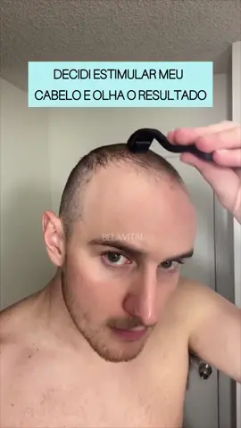 Resultado incrível do uso do dermaroller + massagem circulatória! Está esperando o que para começar o seu tratamento? O próximo vídeo de “Antes x Depois” pode ser o seu! #tratamentocapilar #calvicie #alopecia