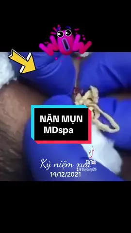 #kỷ niệm xưa #lêthithuydung616 #nặn_mụn #chuyên_đtri_mụn_rỗ_tpvinh_nghệan #nám_tpvinh #mdspa_chuyên_mụn_rỗ_tpvinh 
