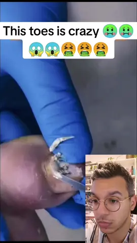 #pimples_brufoli #blackdots #acne #pimples #brufoli #popping #pimplepop #face #pimple #zits #blackhead #nose #satisfying #pimpleremover #pimplepopper #blackheadsremoval #puntosnegros #pimplepopperaddict #acné #acne #bouton #explosion #problemeacne #imperfection #visage #acnéique #bouton #kyste #furoncle #furoncles  #satisfying #extractions #blackhead #satisfaction #toe #toenail #toenailremoval #toenails #nail #ingrownnail #ingrowntoenail #ingrownnails #ingrownnail😢😰 