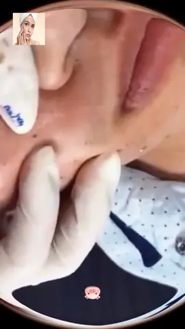 #squeeze #squeezeyuk #acne #pimple #pimplepop #blackhead #satisfying #foryoupage 50