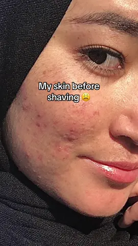 Make sure to use aloe vera gel before shaving. (It comes for free in our shvaing kit). And moisturise after shaving #beautytips#BeautyTok#shavingmyfaceasagirl#dermaplaningbenefits#kimyaglow#shavingtipsforgirls#acne#acnetreatment#acnejourney#shavingtips#shavingmyface#shavingtipsforwomen#dermaplaningathome#shavingmyfaceasawoman   