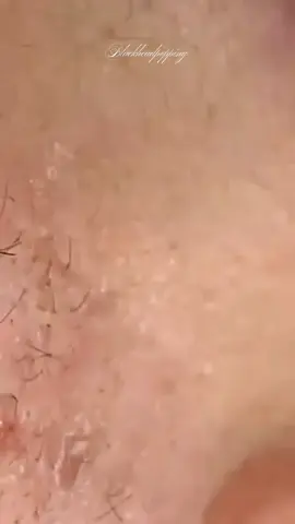 blackheads relaxing 😍 @Blackheadspopping  @Blackheadspopping #pointnoirs#extractions#acne#skincare#tiktoklongs#foryou#blackheads#fyp#pourtoi 