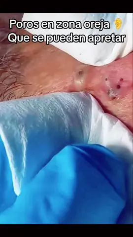 #Extracción #poros #granos#pelo #espinillas #limpiezafacial #acne #tratamientos 