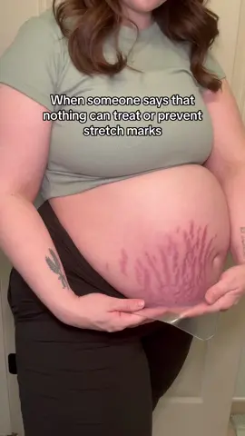 Clinically proven 💯 #stretchmarks #stretchmarksremedy #stretchmarkcamouflage 
