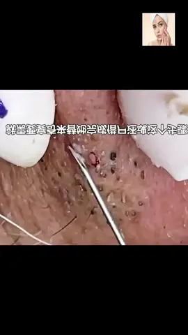#squeeze  #squeezeyuk  #acne  #pimple  #pimplepop  #blackhead  #satisfying  #foryoupage