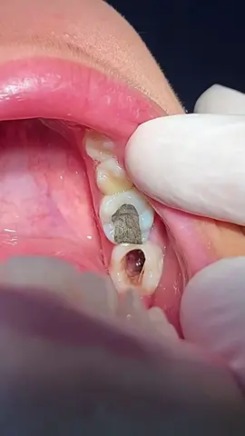 Deep caries #caries #dentist #teeth #طبيب_اسنان #tooth #dentista #VNVideoEditor 