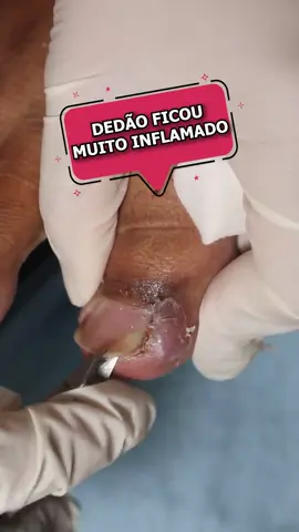 Esse dedão ficou muito inflamado.. #ingrowntoenailremoval #unhaencravada #ingrowntoenail #unhasencravadas #uñaencarnada 