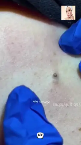 #squeeze  #squeezeyuk  #acne  #pimple  #pimplepop  #blackhead  #satisfying  #foryoupage