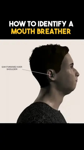 How to Identify a Mouthbreather #mewing  #mouthbreathing  #jawline  #orthodontics
