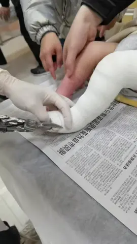 This is how a cast is removed from a childs leg