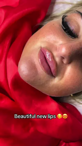 How much better cant cope 😩✨ #lipfiller #russianlips #lipinjetions #fyp #lipdissolving #migratedfiller 