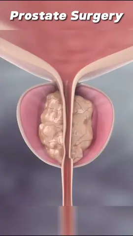 Prostate Surgery 3D Animation #prostatesurgery #prostatecancer #prostateproblems #maleprostatecancer #prostate #medical3danimation #3dmedicalanimation