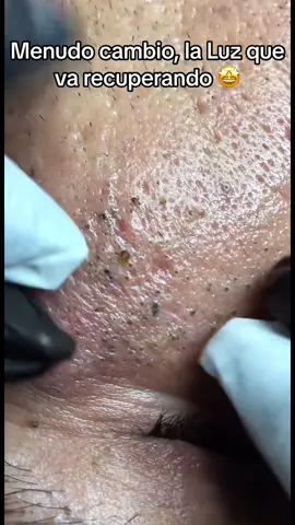 #extractions#puntosnegros#acne #grasa#espinillas #granos #poros #facial #relajante 