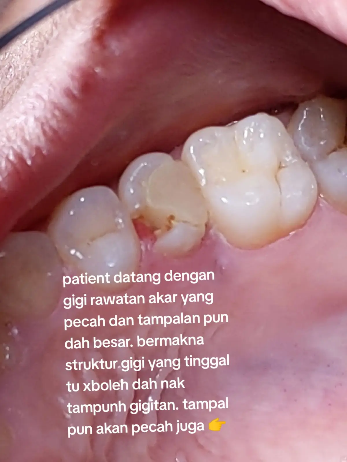 jika anda ada masalah yg sama, datang jumpa Dentist. sebenarnya banyak rawatan dengan teknologi sekarang utk baiki gigi. crown adalah salah satu option shj. byk lagi alternative lain. orang kita ni fah, sakit gigi je, trus fikir cabut.#senyumitusedekah #klinikgigikelantan #klinikgigikotabharu #dentist #klinikpergigianamalmedik #dentalcrown 