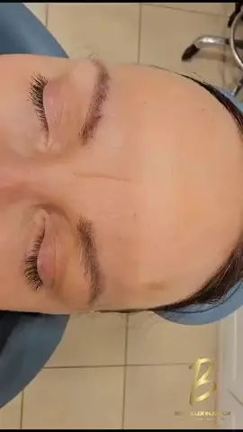 Treating the corrugator muscle. #bestfillerinjector #fypage #parati #botoxglabella 