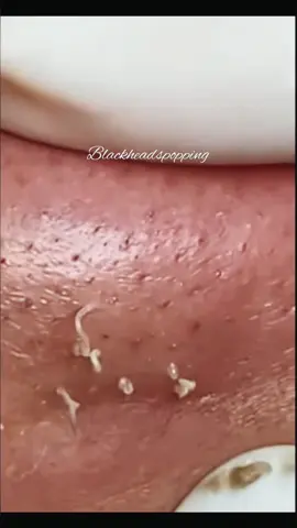 Super extraction 🥰 @Blackheadspopping  @Blackheadspopping  @Blackheadspopping #pointnoirs #tiktoklongs #acne #skincare #kyste #foryou #explore 