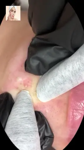 #squeeze  #squeezeyuk  #acne  #pimple  #pimplepop  #blackhead  #satisfying  #foryoupage