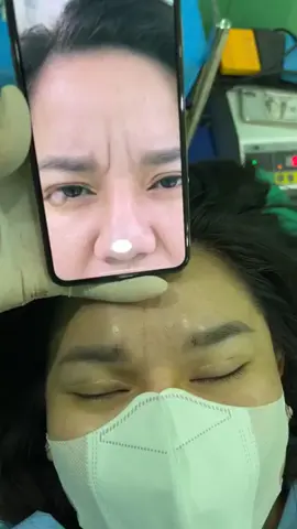 Xoá nhăn ấn đường cho bạn khách trẻ.!!