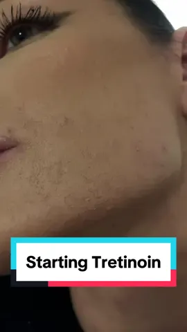 In our 🍌 tretinoin phase.  Who all uses tretinoin? So excited for my journey 🤗 #viral #fyp #foryoupage #selflove #acne #acnetreatment #acneskin #acnefighter #texturedskin #hormonalacne #acnescars #tretinoin #tretinoinjourney 
