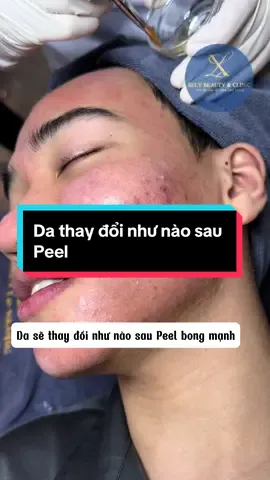 Bong hơi mệt nhưng kết quả xứng đáng nhỉ #xulybeauty #trimun #peel 