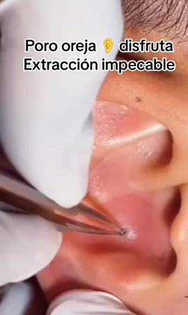 #Extracción #poros #granos#pelo #espinillas #limpiezafacial #acne #tratamientos 