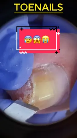 Toenails #toenails #nails #nailsremoval #foryou #spa 