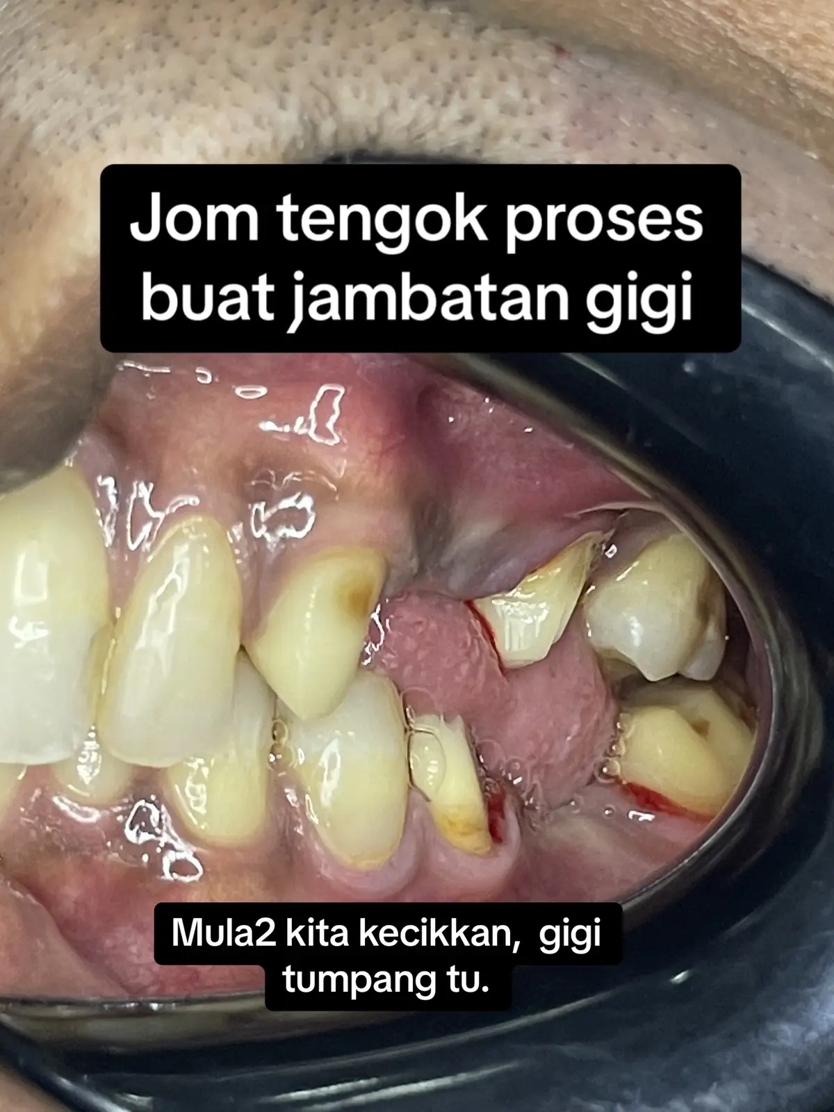 #dentistpasirgudang #doktorgigipasirgudang #dentalclinicpasirgudang #klinikgigipasirgudang #fypシ゚viral #shouldbeme #fyp #fypage #pasirgudang #jbstyle #jbstyle🔥 #pasirgudangproblem #drqdentistpasirgudang #dentalbridge #dentalbridgepasirgudang 