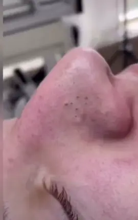 #cravos #brufoli #blackhead #zit #pimples_brufoli_ #popping #asmr #zits #pimples #granos #acne #popper #pimple #pimples_brufoli #granosyespinillas #pimplepop 