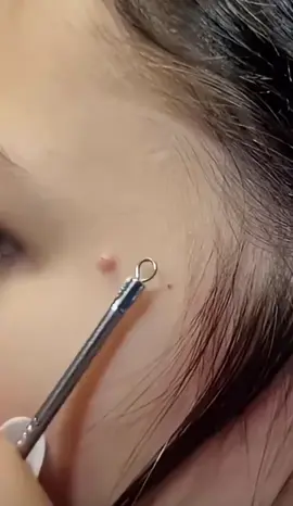 #cravos #brufoli #blackhead #zit #pimples_brufoli_ #popping #asmr #zits #pimples #granos #acne #popper #pimple #pimples_brufoli #granosyespinillas #pimplepop 