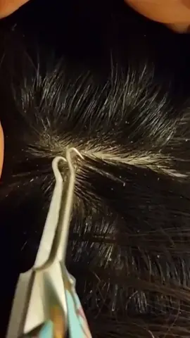 #scalpcheck #scratching #satisfying #twezeers #hair #massage #longnails #dandruff #dandruff #relaxing #flakes #sleeping #fyp  #sounds #triggers #cleaning #forsleep #tingly #ASMR #remove 