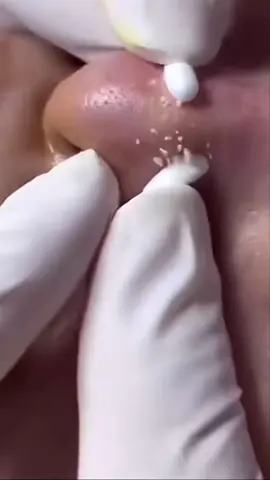 #extractions#puntosnegros#acne #grasa#espinillas #granos #poros #facial #relajante 