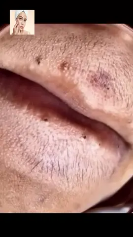 #acne  #pimple