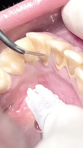 Scaling tartar & calculus from lower anterior teeth #dentist #tartar #calculus #dentista #طبيب_اسنان #teeth 